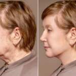 DEEP PLANE FACELIFT IN BARCELONA: WHAT MAKES THIS TECHNIQUE DIFFERENT?