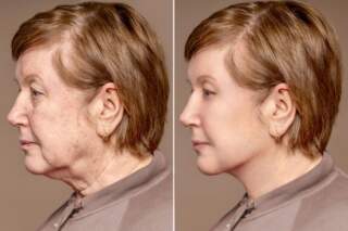 DEEP PLANE FACELIFT IN BARCELONA: WHAT MAKES THIS TECHNIQUE DIFFERENT?