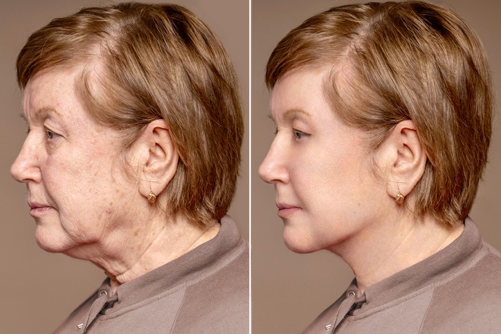DEEP PLANE FACELIFT IN BARCELONA: WHAT MAKES THIS TECHNIQUE DIFFERENT?